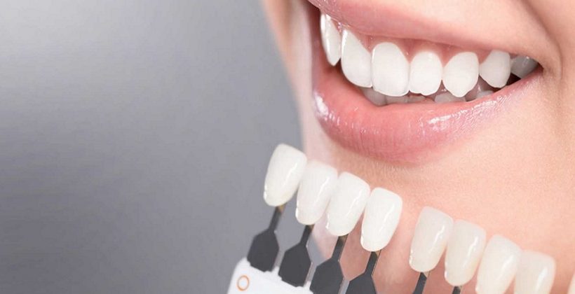 Лучшие способы отбеливания зубов